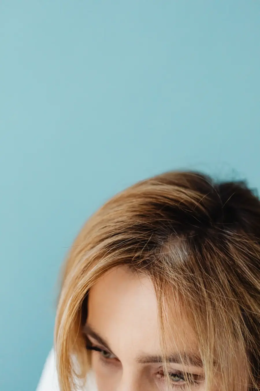 Seborrheic dermatitis